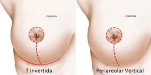 mastopexia barrancabermeja