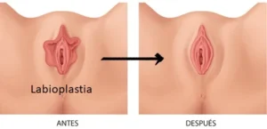 rejuvenecimiento vaginal barrancabermeja