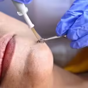 eliminar verrugas barrancabermeja