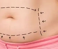 Abdominoplastia en Barrancabermeja abdominoplastia barrancabermeja