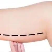 Braquioplastia en Barrancabermeja Braquioplastia barrancabermeja