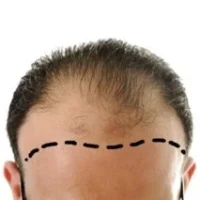 Implante capilar en Barrancabermeja implante capilar barrancabermeja