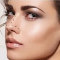 Rinoplastia Barrancabermeja rinoplastia barrancabermeja